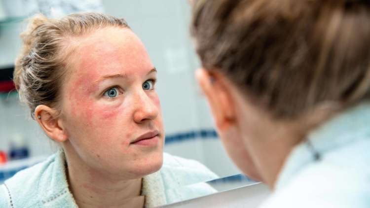 Read more about the article To so simptomi perioralnega dermatitisa