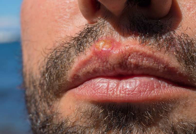 Read more about the article Pretirano sončenje lahko izzove herpes