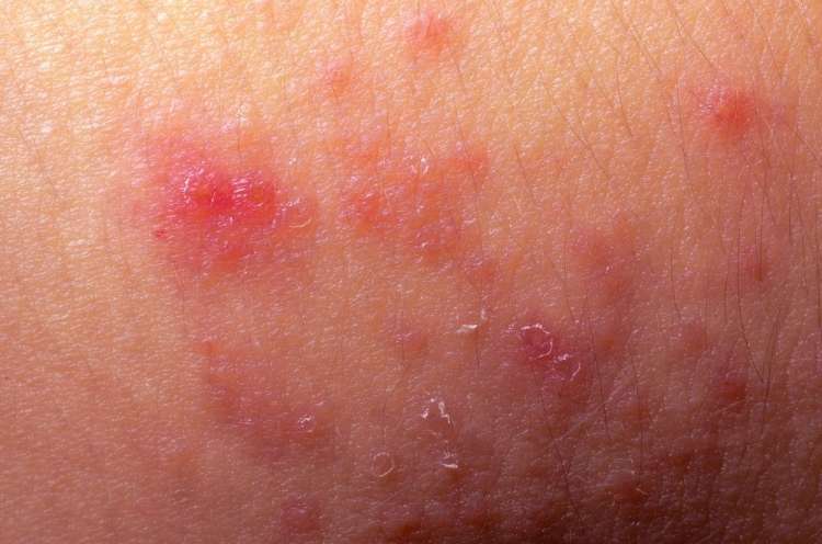 Read more about the article So ti izpuščaji znak za atopijski dermatitis ?